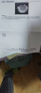 停经50天,月经50天没来正常吗