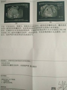 停经50天,月经50天没来正常吗