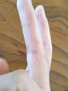 手指上长了很多小颗粒很痒,为什么手上起小颗粒很痒