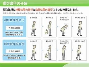 跛行是什么意思,什么叫间歇跛行