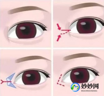 开内眼角好看吗,开内眼角有什么效果