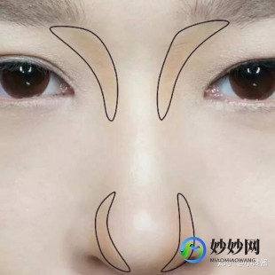 驼峰鼻怎么改善,驼峰鼻的四种矫正方法