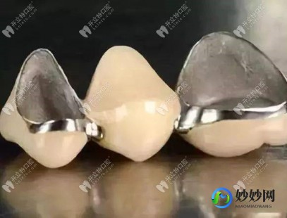 钯金烤瓷牙,钯金烤瓷牙优缺点
