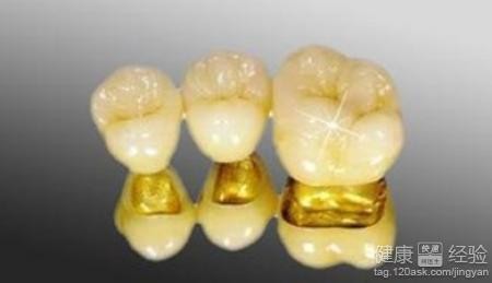 钯金烤瓷牙,钯金烤瓷牙优缺点