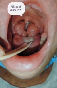 腺样体残留,腺样体残留