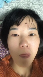 面瘫多久开始恢复,面瘫从第几天开始恢复