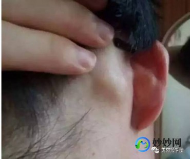 耳后淋巴结,耳朵后面淋巴结