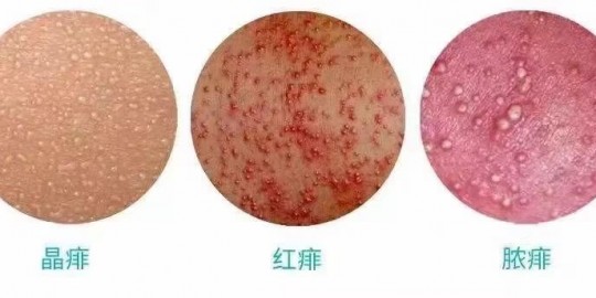 痱子怎么办,起痱子怎么办
