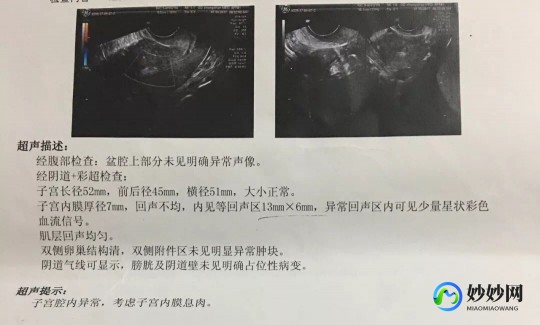 妇科检查图片,妇科彩超怎么做过程图片