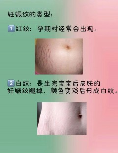 祛妊娠纹,怎么去除妊娠纹