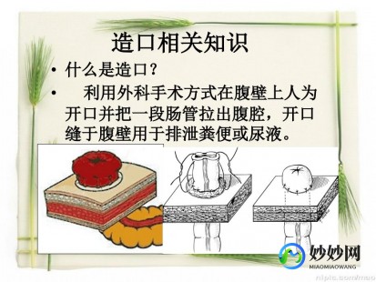 造瘘,造瘘患者应如何护理
