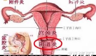 怎么通输卵管,输卵管堵塞有什么办法可以疏通