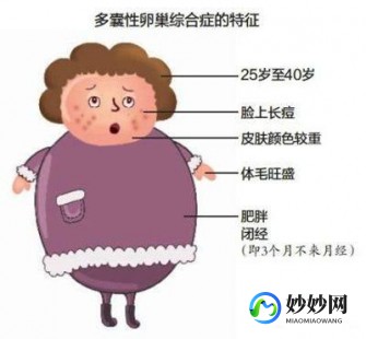 多囊卵巢综合症的症状,多囊卵巢综合症症状有哪些
