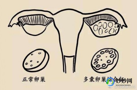 多囊卵巢综合症的症状,多囊卵巢综合症症状有哪些