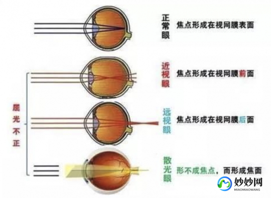 远视性弱视,远视性弱视