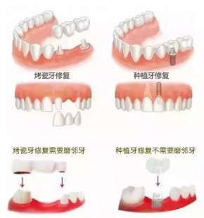 牙齿松动了能恢复吗,牙齿松动了能恢复吗