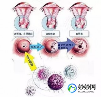 怎么排除是不是宫颈癌,怎么排除是不是宫颈癌