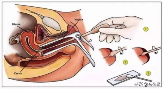 宫颈息肉需要做手术吗,宫颈息肉要不要做手术去掉