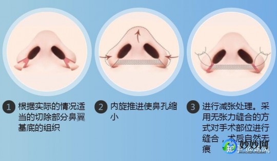 鼻翼缩小术费用,缩鼻翼手术大概要多少钱