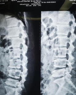 腰突的怎么了,腰椎间盘突出怎么回事
