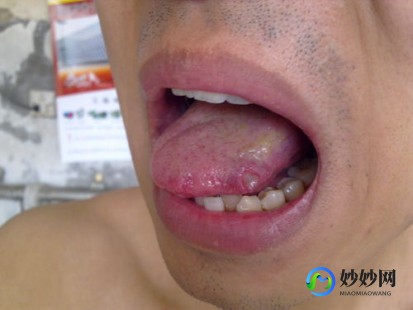 口瘙痒是怎么回事,口特别痒
