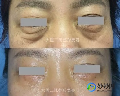 打祛眼袋针,打针去眼袋能保持多久