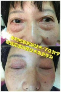 打祛眼袋针,打针去眼袋能保持多久