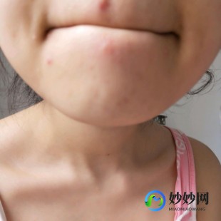 下巴长痘痘,下巴有个小疙瘩
