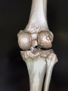 游离体,关节腔后方显示游离体是什么