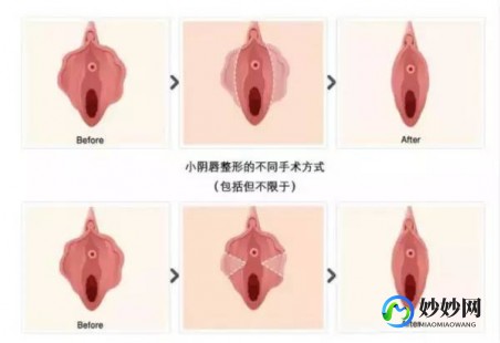 小阴脣大阴脣长什么样,正常的是什么样的