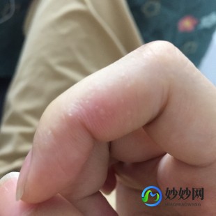小水泡,皮肤下有小水泡