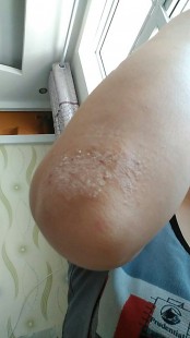 手臂皮肤粗糙,手臂上皮肤一块块粗糙