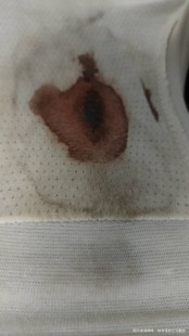 同房后有点出血,做完那个之后为什么会有血