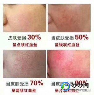 激光去红血丝会反弹吗,激光去红血丝会反弹吗