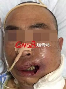 男生挤痘流血近1小时-用了400张纸,青春痘破了流血怎么办