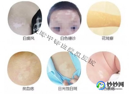 白殿风的症状,白癜风有什么症状