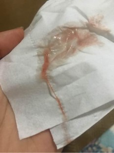 水样白带,留水样的白带怎么回事