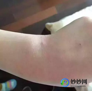 疱疹性咽峡炎五个分期,疱疹性咽峡炎四个时期
