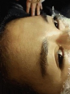 点阵激光祛痘坑,点阵激光去痘坑需要几次才能彻底消除