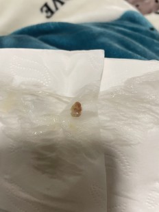 新冠咳嗽出一坨一坨的黄痰,阳性后咳出块状黄痰怎么回事怎么办