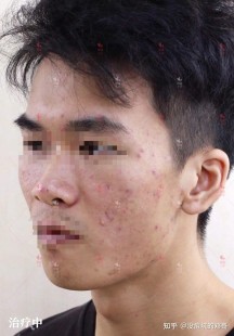 去除痘坑,脸上很多痘坑怎么处理