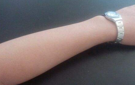 手部脱毛,手毛多怎么办