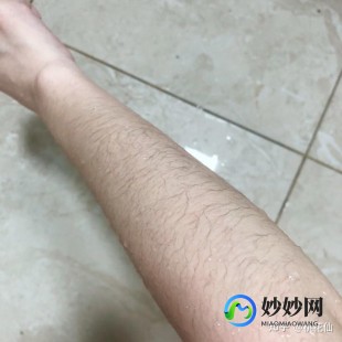 手部脱毛,手毛多怎么办