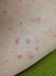 大腿根内侧红斑瘙痒,大腿根部内侧瘙痒发红