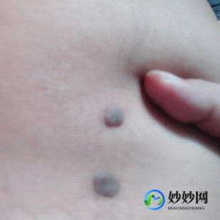对金属过敏,对金属过敏怎么办