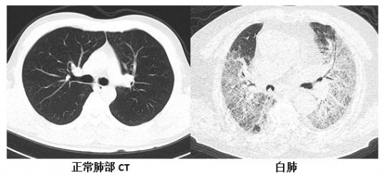 白肺,白肺是什么意思