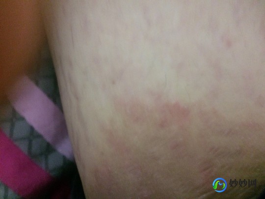 大腿根内侧红斑瘙痒,大腿内侧红色斑块瘙痒