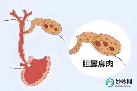 治疗胆囊息肉,如何消除胆囊息肉