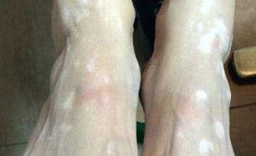白颠的症状,白癜风有什么症状