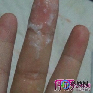 白色粘稠液体,粘稠白色白带怎么回事